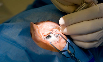 Smile laser eye surgery