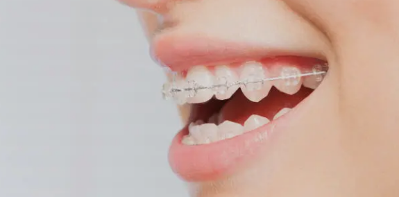 dental braces Adelaide